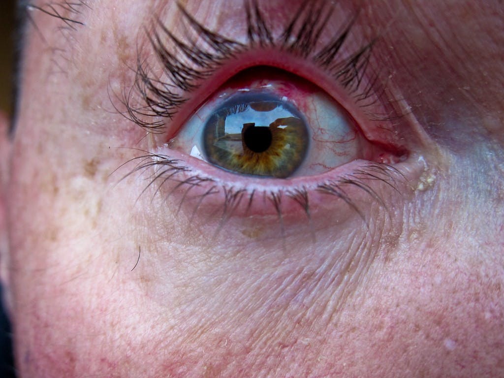 زرع عضو اصطناعي قد يستعيد الرؤية لمصابي التهاب الشبكية الصباغي